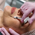Nasolabial Folds (Smile Lines)